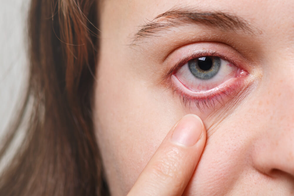 Understanding the Impact of Stye on Vision: Symptoms You Should Be Aware Of